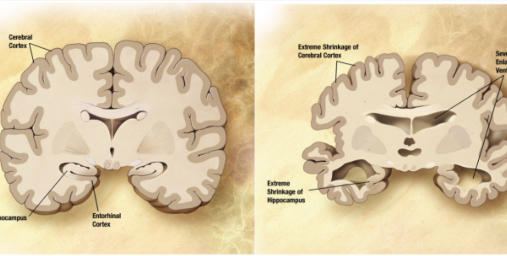 Alzheimer’s_disease_brain_comparison CC BY-SA wikipedia